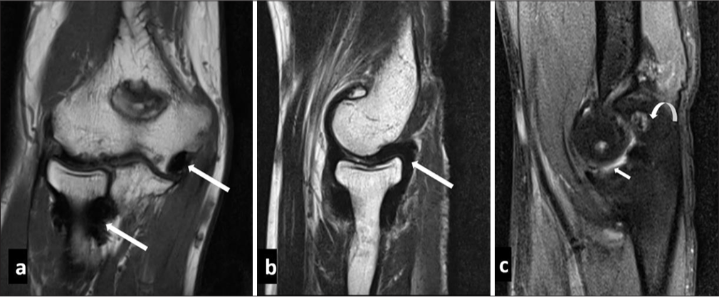(a) Coronal T1 weighted, (b) sagittal T2 weighted and (c) proton density fat saturated images in a haemophilic patient reveal synovial thickening which appears hypointense on both T1 and T2 weighted images (white arrow in a and b) suggestive of hemosiderin deposition. Also note associated mild joint effusion (small white arrow in c) and articular surface erosions (curved arrow in c).