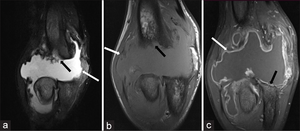 (a) Coronal T2 weighted fat saturated, (b) coronal T1 weighted and (c) coronal post contrast images in a patient with neuropathic arthropathy reveal disorganization of elbow joint with gross joint effusion and synovial enhancement (white arrow in a-c). In addition, there is complete resorption of distal humerus (black arrow in a, b), proximal ulna (black arrow in c) and radial head.