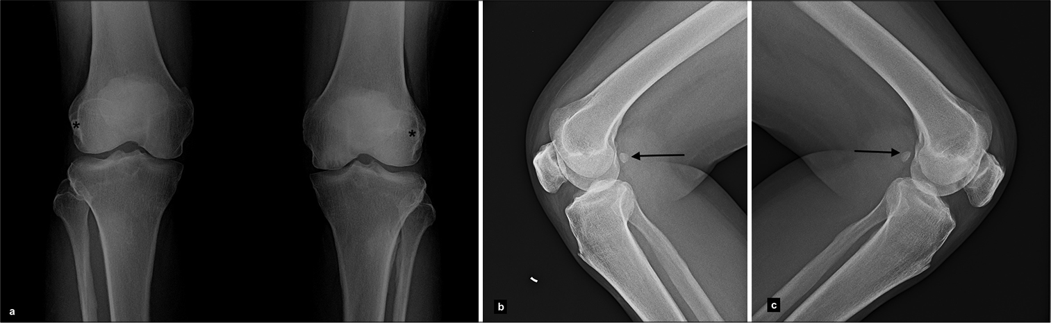 (a) Radiograph anteroposterior view (b and c) lateral view of both knees in a subject shows fabella present bilaterally (black asterix in a and black arrows in b and c).