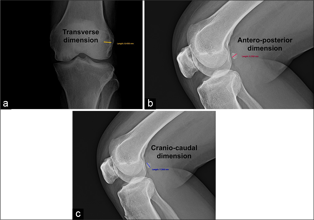 Radiograph anteroposterior view and lateral views of the same subject showing technique of measurement of the fabella in (a) transverse dimension, (b) anteroposterior dimension, and (c) craniocaudal dimension.