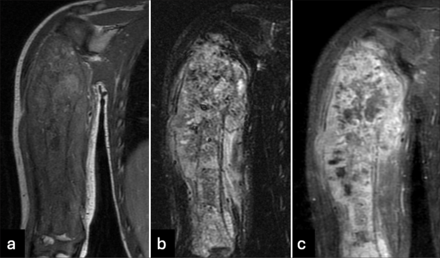 (a) T1, (b) T2 short tau inversion recovery, and (c) T1 post-contrast images of the right humerus show a diffuse and aggressive infiltrative process involving the length of the humerus with a pathological fracture of the proximal diaphysis. There is an asymmetrically thick circumferential rind of heterogeneously enhancing soft tissue mass. There is transphyseal extension into the humeral head with suspected involvement of the glenohumeral joint.
