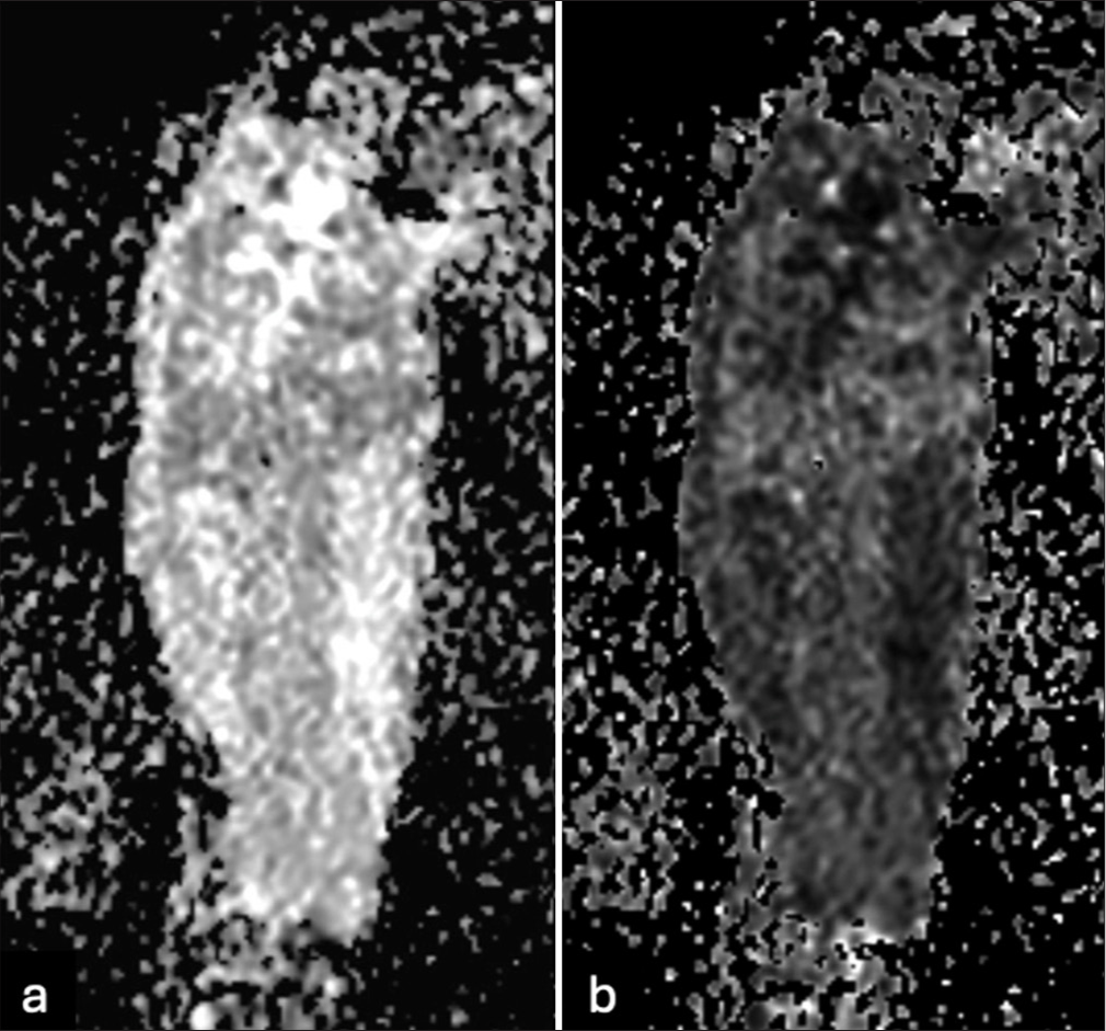 (a) Diffusion-weighted imaging and (b) apparent diffusion coefficient maps show restricted diffusion throughout the osseous and extraosseous components of the diffusely infiltrative process involving the entire humerus length.