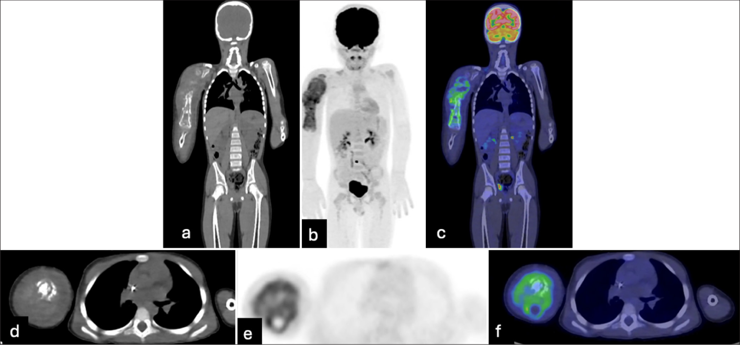 Whole-body positron emission tomography/computed tomography demonstrates a hypermetabolic tumor involving the entire right humerus with surrounding soft tissue components. There is no evidence of local or distant hypermetabolic metastatic disease.
