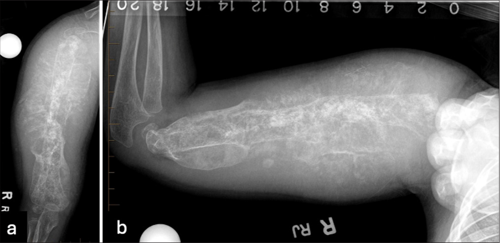 (a) Antero-posterior and (b) lateral radiographs of the right humerus demonstrate an extensive lytic and sclerotic process involving the entire length of the humerus with a marked increase in thickness of heterogeneous calcification along the length of the humerus. The abnormality seen along the cortex has a more organized morphology, especially distally. The cortical and medullary detail is partially obscured by extensive periosteal new bone formation.