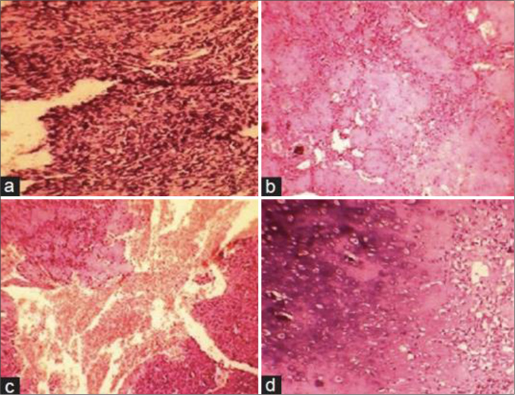 Photomicrograph showing (a) malignant spindle-shaped cells (b) Osteoid with pleomorphic cells (c) Large areas of hemorrhage with endothelial-lined vascular areas and neoplastic cells (d) Chondroblastic areas (H&E, x100).