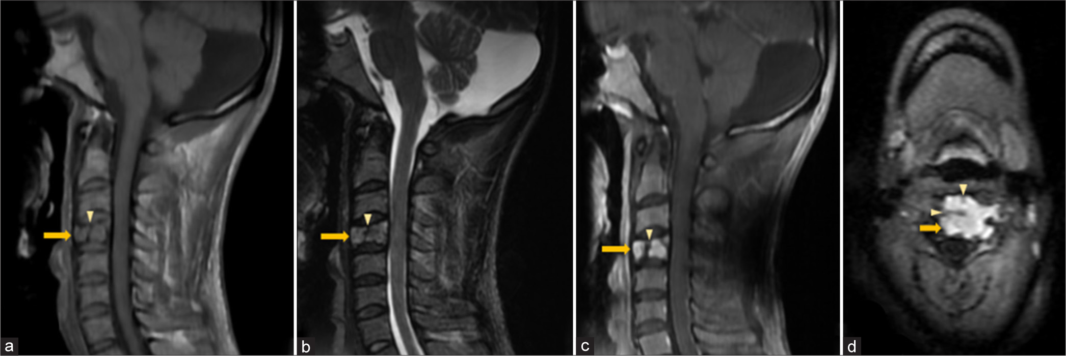 Vertebral plasmacytoma – Sagittal (a) T1W, (b) T2W, (c) Post-contrast T1-FS and (d) axial FLAIR magnetic resonance images of cervical spine show a homogeneously enhancing geographic expansile lesion (solid arrow in a-d) in the posterior aspect of C4 vertebral body appearing hypointense on T1W and hyperintense T2W sequences with thick hypointense intralesional cortical struts (arrowhead in a-d) giving “mini-brain” appearance. FLAIR: Fluid attenuated inversion recovery, FS: Fat saturated.