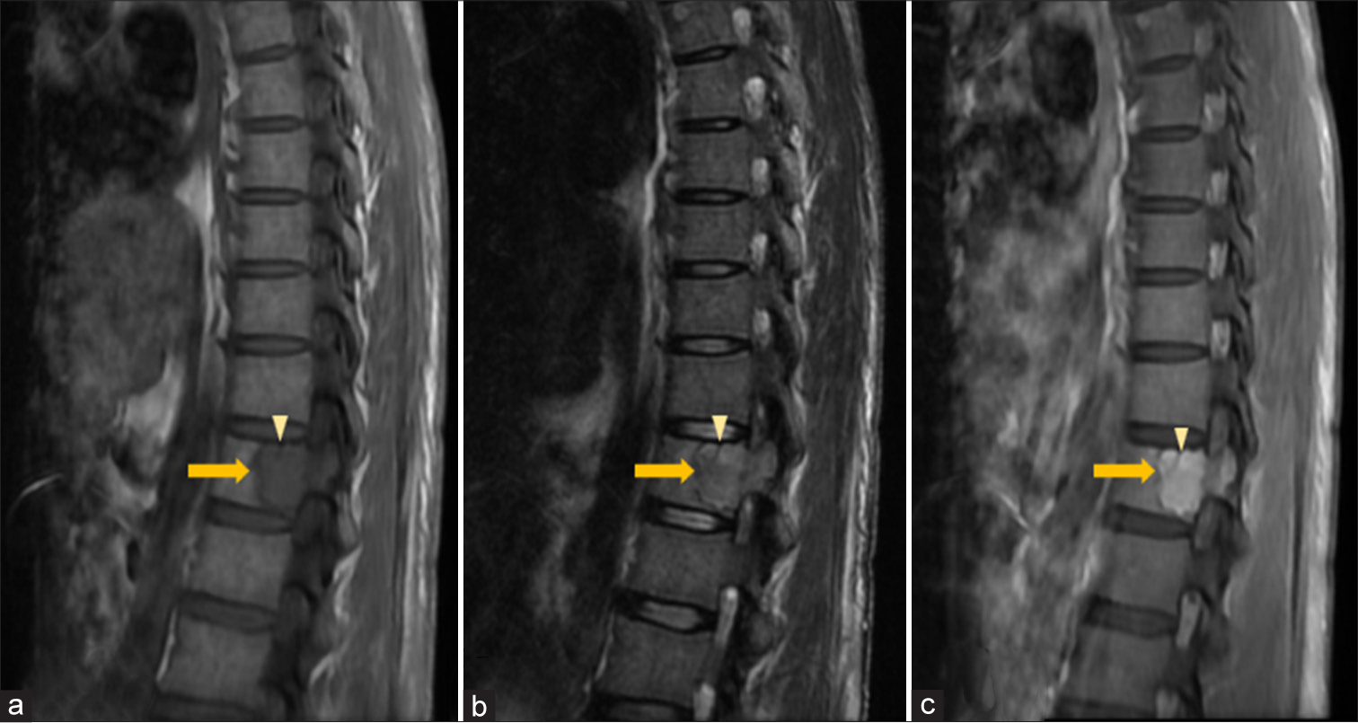 Vertebral plasmacytoma – Sagittal (a) T1-weighted (T1W), (b) T2-weighted (T2W) and (c) Post-contrast T1-FS magnetic resonance images of thoracic spine show a homogeneously enhancing geographic expansile lesion (solid arrow in a-c) in the posterior aspect of T12 vertebral body and left pedicle appearing hypointense on T1W and hyperintense T2W sequences with a thick hypointense intralesional cortical strut (arrowhead in a-c) giving “mini-brain” appearance. FS: Fat saturated.