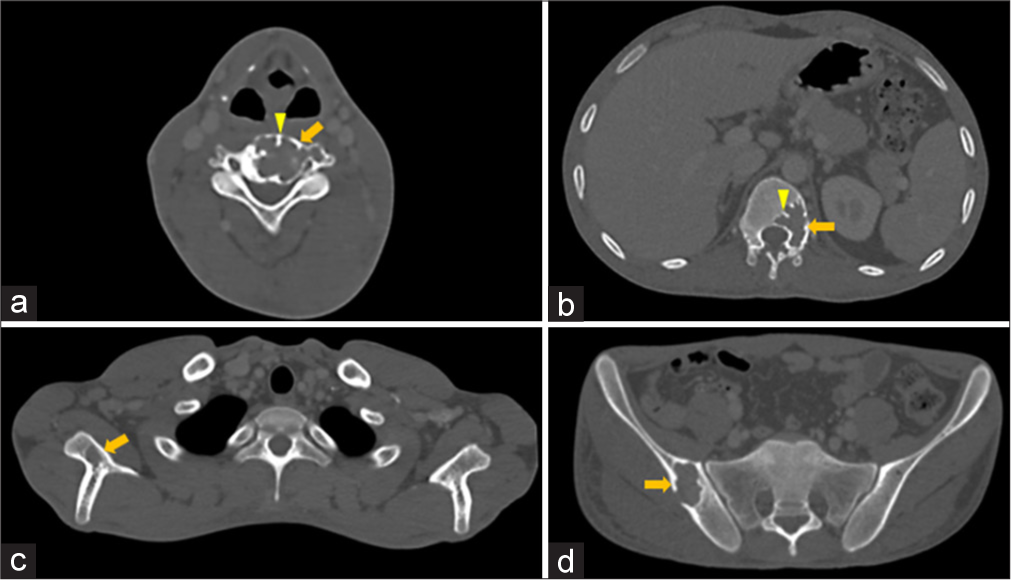 (a-d) Osteolytic plasmacytomas – Axial computed tomography images in bone window show geographic expansile osteolytic lesions (solid arrow in a-d) with sclerotic margins and focal areas of cortical breach in (a) C4 vertebral body and left transverse process, (b) T12 vertebral body and left pedicle, (c) right scapula, and (d) right iliac blade with thick intralesional cortical struts (arrowheads in a-d) giving “mini-brain” appearance.