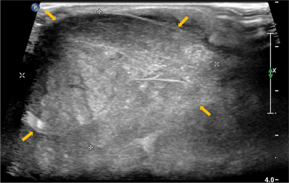 Cervical lymph node – Short axis gray-scale sonographic image of right level III cervical lymph node showing marked enlargement and solid non-necrotic heterogeneous echotexture with effacement of normal fatty hilar morphology (yellow arrows) (biopsy showed histomorphology of Castleman’s disease).