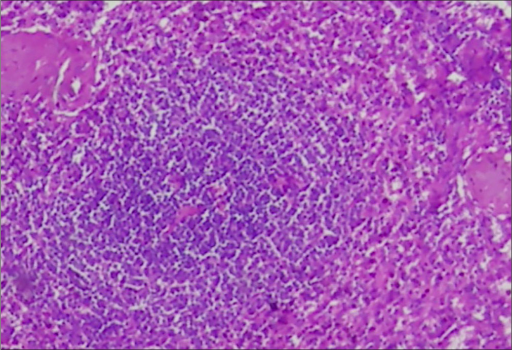 Histopathological image of a lymph node showing features of (Hematoxylin and Eosin, 40X). Castleman’s disease -atretic follicles with hyalinized blood vessels.