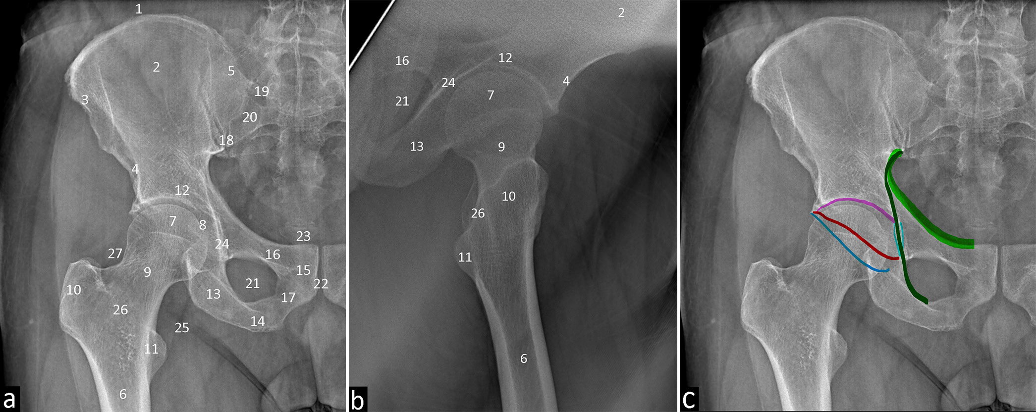 Radiographs of the Hip (a) Frontal projection 1. Iliac crest. 2. Ilium. 3. Anterior superior iliac spine. 4. Anterior inferior iliac spine. 5. Posterior superior iliac spine. 6. Femur. 7. Femoral head. 8. Fovea centralis. 9. Femoral neck. 10. Greater trochanter. 11. Lesser trochanter. 12. Acetabulum. 13. Ischium. 14. Ischial tuberosity. 15. Pubis. 16. Superior pubic ramus. 17. Inferior pubic ramus. 18. Sacroiliac joint. 19. Sacral Arcuate lines. 20. Anterior sacral foramina. 21. Obturator foramen. 22. Symphysis pubis. 23. Coccyx 24. Koehler’s teardrop 25. Psoas fat pad 26. Intertrochanteric crest 27. Gluteal fat pad, (b) Lateral projection 2. Ilium. 4. Anterior inferior iliac spine. 6. Femur. 7. Femoral head. 9. Femoral neck. 10. Greater trochanter. 11. Lesser trochanter. 13. Ischium. 16. Superior pubic ramus. 21. Obturator foramen. 24. Koehler’s teardrop. 26. Intertrochanteric crest. (c) Frontal projection demonstrating important lines which are color coded. Light broad green- iliopubic line. Dark thin green- ilioischial line. Pink- Acetabular roof. Red-Anterior acetabular wall. Dark blue-Posterior acetabular wall. Light blue curved-Koehler’s teardrop.