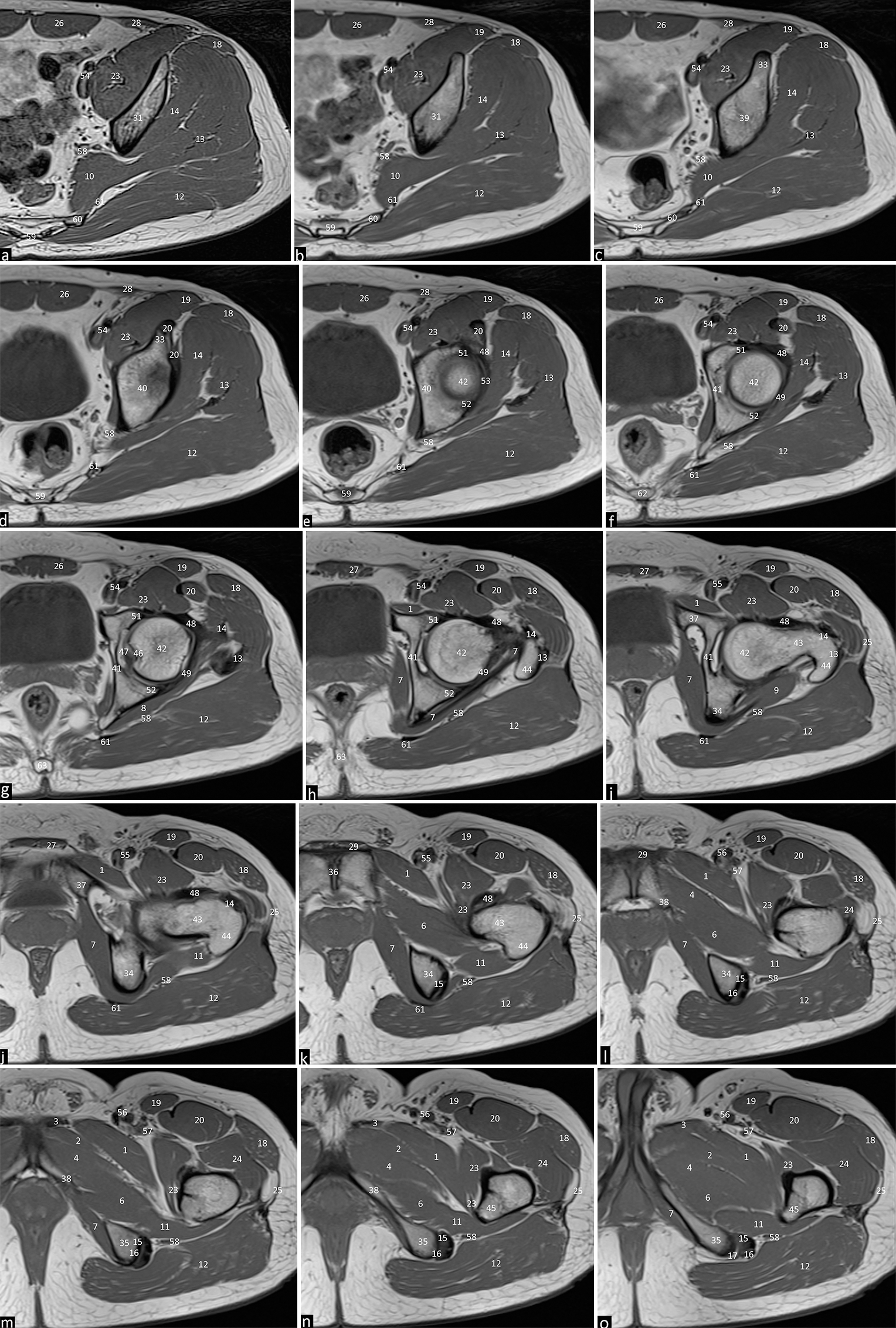 Axial T1 weighted images of the left hip joint depicting the normal anatomical structures from Cranial to caudal with subpart images. (a-o) 1. Pectineus. 2. Adductor brevis. 3. Adductor longus. 4. Adductor magnus. 5. Gracilis. 6. Obturator externus. 7. Obturator internus. 8. Superior gemellus. 9. Inferior gemellus. 10. Piriformis. 11. Quadratus femorus. 12. Gluteus maximus. 13. Gluteus medius 14. Gluteus minimus. 15. Semimembranosus. 16. Long head of biceps femoris. 17. Semitendinosus. 18. Tensor fascia lata. 19. Sartorius. 20. Rectus femorus. 21. Iliacus. 22. Psoas major. 23. Iliopsoas. 24. Vastus lateralis. 25. Iliotibial tract. 26. Rectus abdominus. 27. Pyramidalis muscle. 28. Abdominal oblique muscle. 29. Rectus aponeurosis. 30. Coccygeus. 31. Ilium. 32. Anterior superior iliac spine. 33. Anterior inferior iliac spine. 34. Ischium. 35. Ischial tuberosity. 36. Pubic symphysis. 37. Superior pubic ramus. 38. Inferior pubic ramus. 39. Acetabulum. 40. Acetabular roof. 41. Acetabular fossa. 42. Femoral head. 43. Femoral neck. 44. Greater trochanter. 45. Lesser trochanter. 46. Fovea centralis. 47. Ligamentum teres. 48. Iliofemoral ligament. 49. Ischiofemoral ligament. 50. Pubofemoral ligament. 51. Anterior labrum. 52. Posterior labrum. 53. Acetabular labrum. 54. External iliac artery and vein. 55. Common femoral artery and vein. 56. Superficial femoral artery and vein. 57. Profunda femoral artery and vein. 58. Sciatic nerve 59. Sacrum. 60. Sacral ala 61. Sacrotuberous ligament. 62. Sacrococcygeal junction. 63. Coccyx.