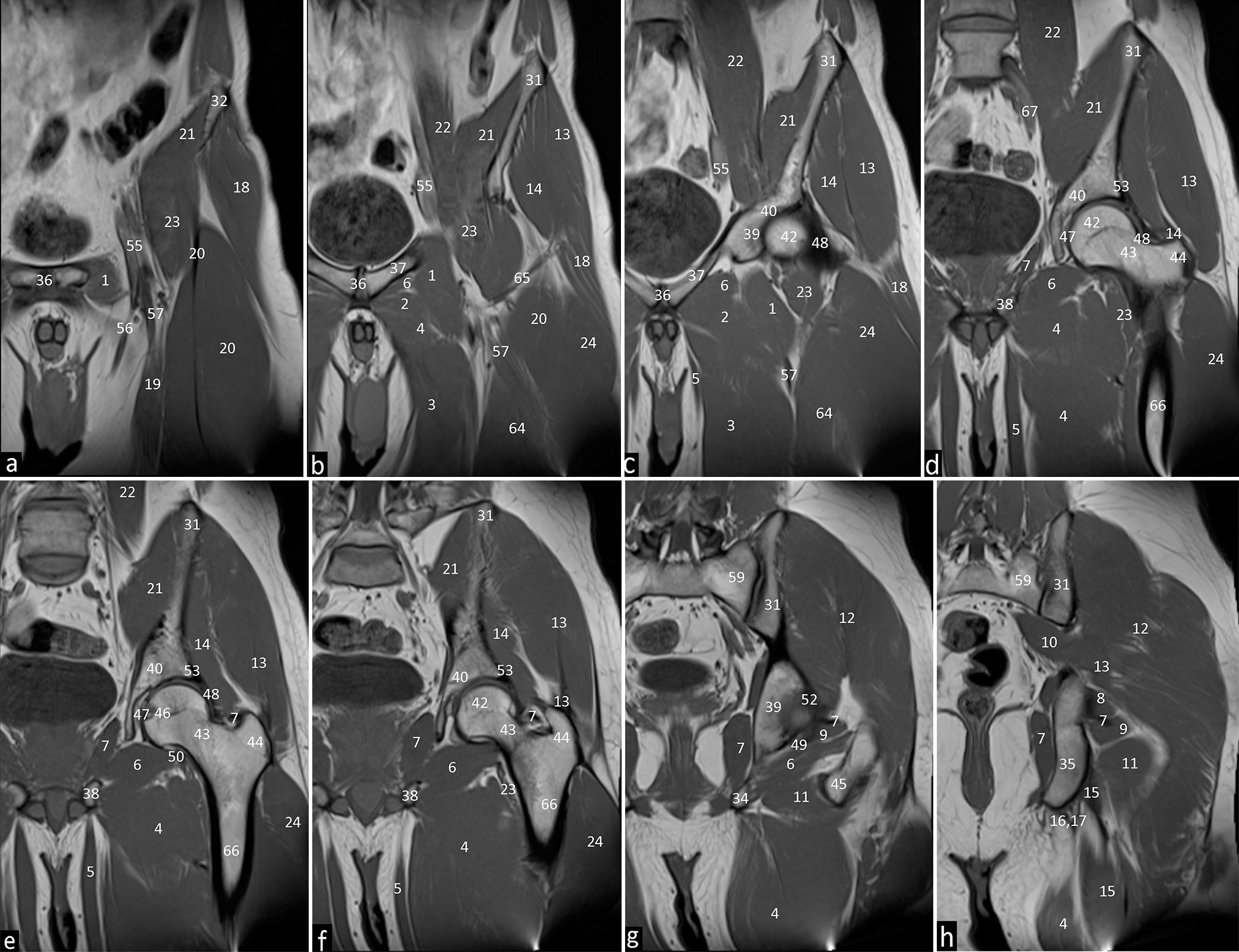 Coronal T1 weighted images of the left hip joint depicting the normal anatomical structures from to anterior to posterior with subpart images. (a-h) 1. Pectineus. 2. Adductor brevis. 3. Adductor longus. 4. Adductor magnus. 5. Gracilis. 6. Obturator externus. 7. Obturator internus. 8. Superior gemellus. 9. Inferior gemellus. 10. Piriformis. 11. Quadratus femorus. 12. Gluteus maximus. 13. Gluteus medius. 14. Gluteus minimus. 15. Semimembranosus. 16. Long head of biceps femoris. 17. Semitendinosus. 18. Tensor fascia lata. 19. Sartorius. 20. Rectus femorus. 21. Iliacus. 22. Psoas major. 23. Iliopsoas. 24. Vastus lateralis. 31. Ilium. 32. Anterior superior iliac spine. 35. Ischial tuberosity. 36. Pubic symphysis. 37. Superior pubic ramus. 38. Inferior pubic ramus. 39. Acetabulum. 40. Acetabular roof. 42. Femoral head. 43. Femoral neck. 44. Greater trochanter. 46. Fovea centralis. 47. Ligamentum teres. 48. Iliofemoral ligament. 49. Ischiofemoral ligament. 50. Pubofemoral ligament. 53. Acetabular labrum. 55. Common femoral artery and vein. 56. Superficial femoral artery and vein. 57. Profunda femoral artery and vein. 59. Sacrum. 64. Vastus intermedius. 65. Lateral circumflex femoral artery. 66. Femoral shaft. 67. External iliac vessels.