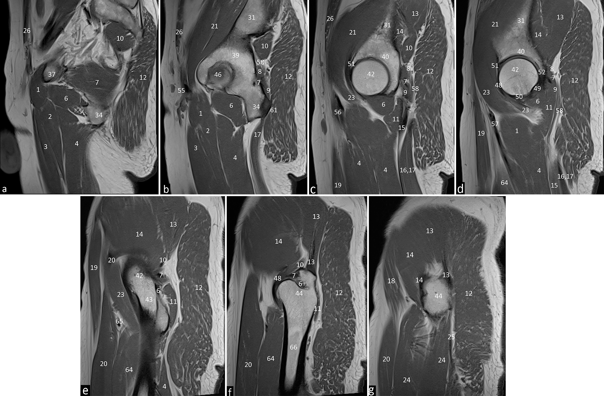 T1 weighted sagittal images of the left hip joint depicting the normal anatomical structures from medial to lateral with subpart images (a-g) 1. Pectineus. 2. Adductor brevis. 3. Adductor longus. 4. Adductor magnus. 6. Obturator externus. 7. Obturator internus. 8. Superior gemellus. 9. Inferior gemellus. 10. Piriformis. 11. Quadratus femorus. 12. Gluteus maximus. 13. Gluteus medius. 14. Gluteus minimus. 15. Semimembranosus. 16. Long head of biceps femoris. 17. Semitendinosus. 18. Tensor fascia lata. 19. Sartorius. 20. Rectus femorus. 21. Iliacus. 23. Iliopsoas. 24. Vastus lateralis. 25. Iliotibial tract. 26. Rectus abdominus. 31. Ilium. 34. Ischium. 37. Superior pubic ramus. 39. Acetabulum. 40. Acetabular roof. 42. Femoral head. 43. Femoral neck. 44. Greater trochanter. 46. Fovea centralis. 48. Iliofemoral ligament. 51. Anterior labrum. 55. Common femoral artery and vein. 56. Superficial femoral artery and vein. 58. Sciatic nerve. 61. Sacrotuberous ligament. 64. Vastus intermedius. 65. Lateral circumflex femoral artery. 66. Femoral shaft. 67. External iliac vessels.