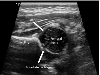 Structures of a normal hip on ultrasonography (standard plane)-the ilial line is identified as a parallel echogenic structure, representing the vertical limb of iliac bone; the unossified femoral head is seen inferior to it. The acetabular labrum and triradiate cartilage are marked by block arrows.