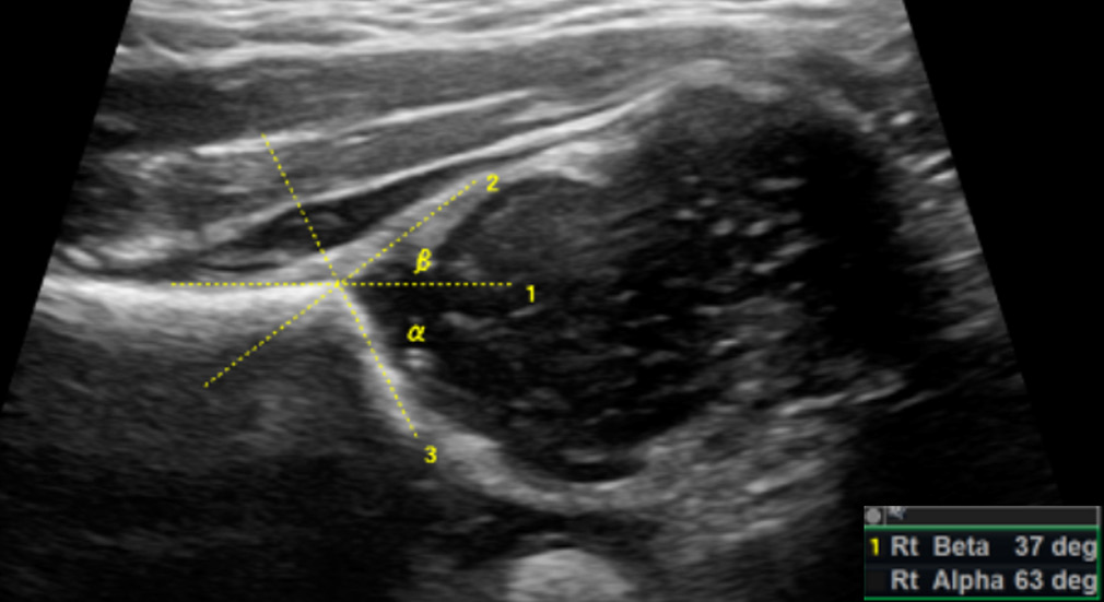 Graf alpha (α) and beta (β) angles in a normal hip-the alpha angle is between the ilial line (1) and the acetabular roof (3) and normally measures >60°. The beta angle is between the ilial line (1) and a line through the acetabular labrum (2) and normally measures <55°.