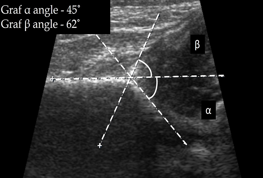 Graf angles in a case of developmental dysplasia of the hip (Graf type II c hip).