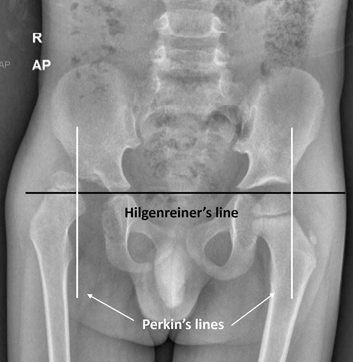 Anteroposterior (AP) radiograph of pelvis with both hips in a child with the right-sided developmental dysplasia of hip, showing Hilgenreiner’s and Perkin’s lines. The normal femoral head (left side) is seen in the inferomedial quadrant whereas the affected femoral head (right side) is dislocated and seen in the superolateral quadrant.