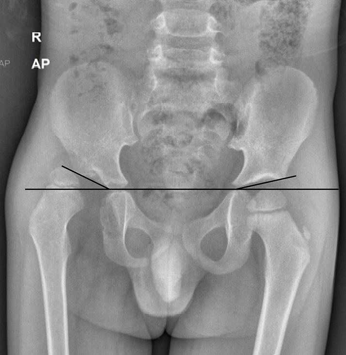 Anteroposterior (AP) radiograph of pelvis with both hips in a child with developmental dysplasia of the right hip. The acetabular index is increased on the right side (30°), whereas it is normal on the left side (15°).