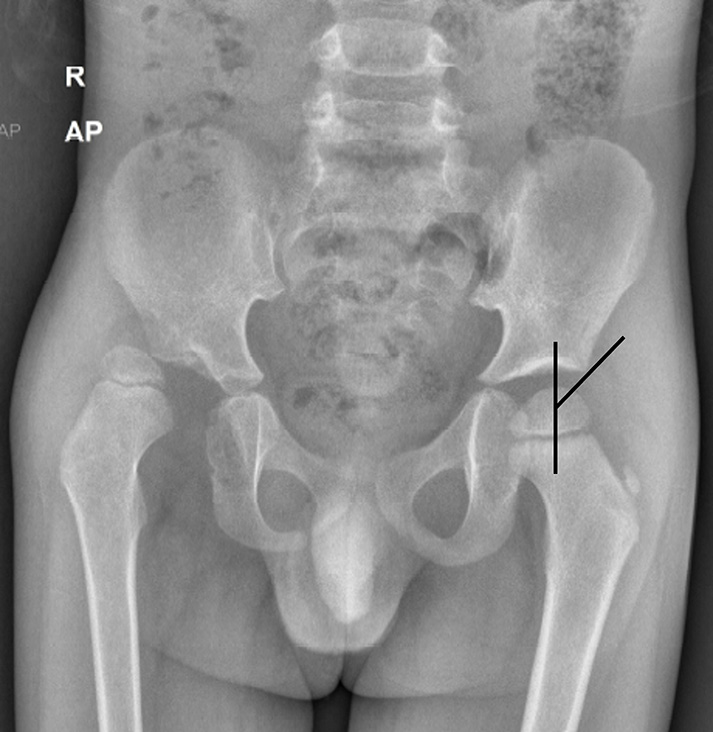 Anteroposterior (AP) radiograph of pelvis with both hips in a child with developmental dysplasia of the right hip shows measurement of central edge angle of Wieberg, which is normal on the left side. However, the lines could not be drawn on the affected side due to dislocation.