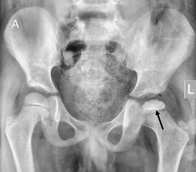 Plain radiograph of the pelvis with both hips showing early signs of Perthes disease in the form of subtle joint space widening, mild reduction in epiphyseal height, and increased density of epiphysis on the left side (black arrow).