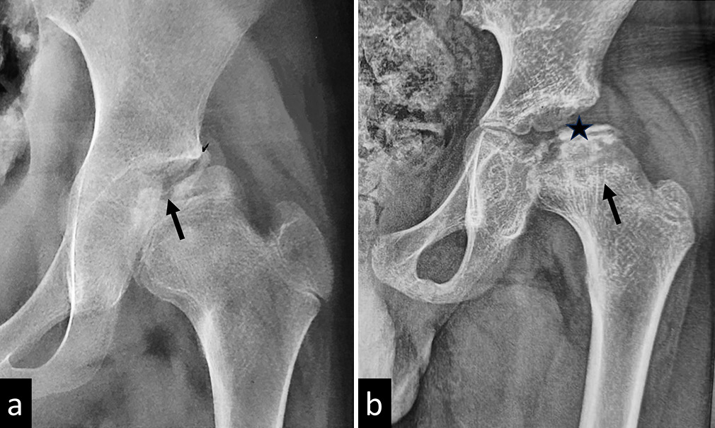 (a) Plain radiograph of a child with Perthes disease showing fragmentation of the femoral epiphysis (black arrow). (b) Plain radiograph of another child with advanced Perthes disease showing complete collapse of the femoral epiphysis (black star) and a concave metaphyseal sclerotic line (black arrow).