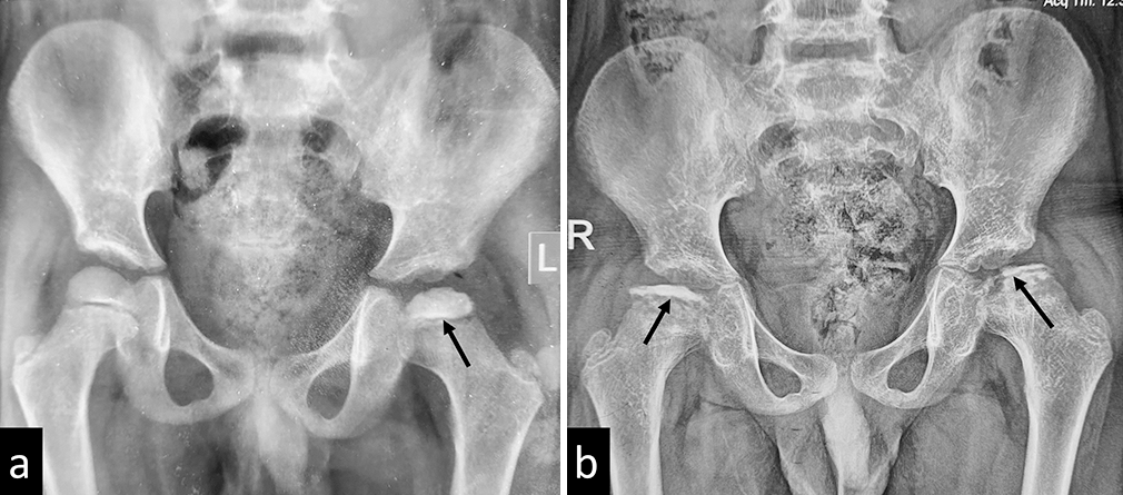 (a) Plain radiograph of a child with Catterall stage I Perthe’s disease of left hip. The arrow shows minimal epiphyseal involvement. (b) Radiograph of the same child showing progression of disease over 11 months to bilateral Catterall Stage IV disease. The arrows show bilateral, total epiphyseal involvement.