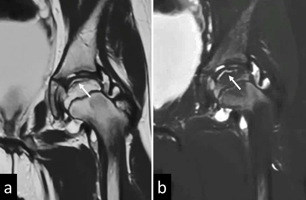 (a) T2 and (b) Short tau inversion recovery (STIR) images of magnetic resonance imaging of the left hip in a child with Perthes disease showing a T2/STIR hyperintense subchondral fracture line (white arrows) suggestive of Crescent sign/Caffey’s sign.