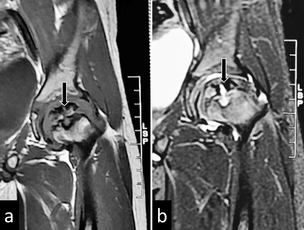 (a) T2 and (b) Short tau inversion recovery images of magnetic resonance imaging of the left hip in a child with Perthes disease showing disintegrated ossific nuclei (black arrows).