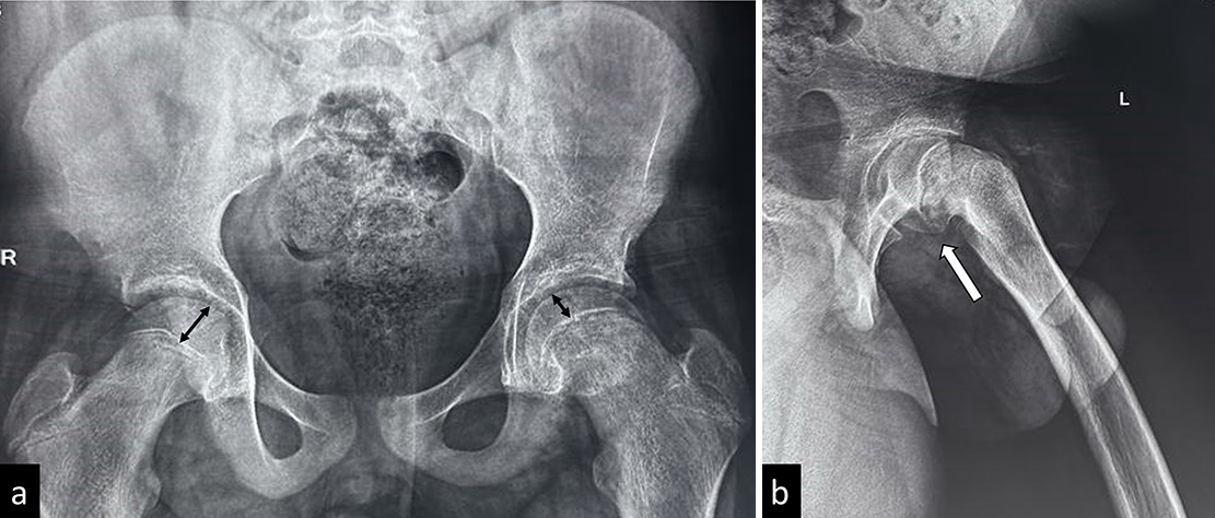 (a) Frontal and (b) frog-leg lateral views in a child with slipped capital femoral epiphysis highlighting the importance of frog leg lateral view-the frontal radiograph shows that only subtle disparity is seen in epiphyseal heights (reduced height on left side), whereas the slip better appreciated in the frog leg lateral radiograph.