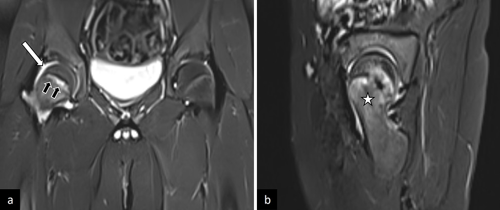 (a) Coronal, and (b) sagittal T2-weighted images in a patient with pre-slip stage of right sided slipped capital femoral epiphysis. There is widening of the physis (black arrows in a), with synovitis and joint effusion (white arrow in a) and marrow edema of the metaphysis (white asterik in b). This patient had a complete slip on follow-up imaging.