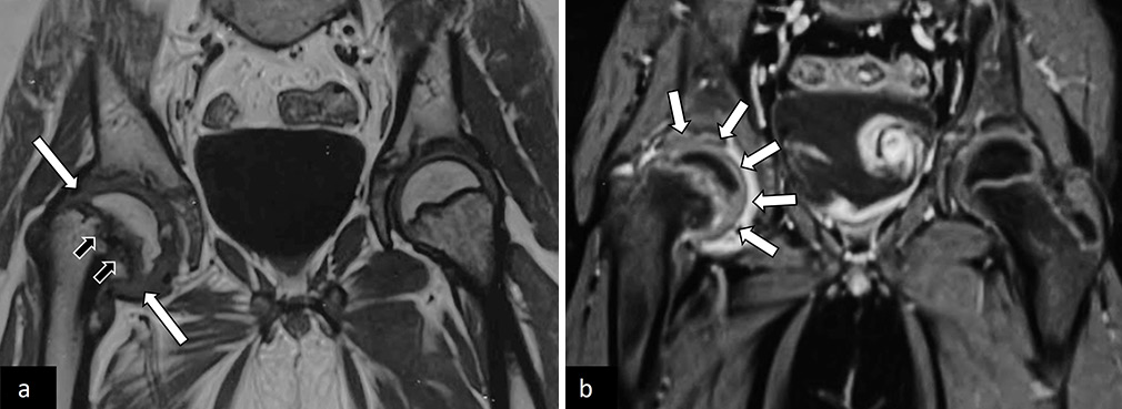 (a) Coronal T1-weighted and (b) post-contrast magnetic resonance images of pelvis with both hip joints in an adolescent with the right-sided limp, showing slipped right capital femoral epiphysis (white arrows in a) with periphyseal bone marrow edema (black arrows in a). There was associated synovitis (white arrows in b) with no suggestion of avascular necrosis.