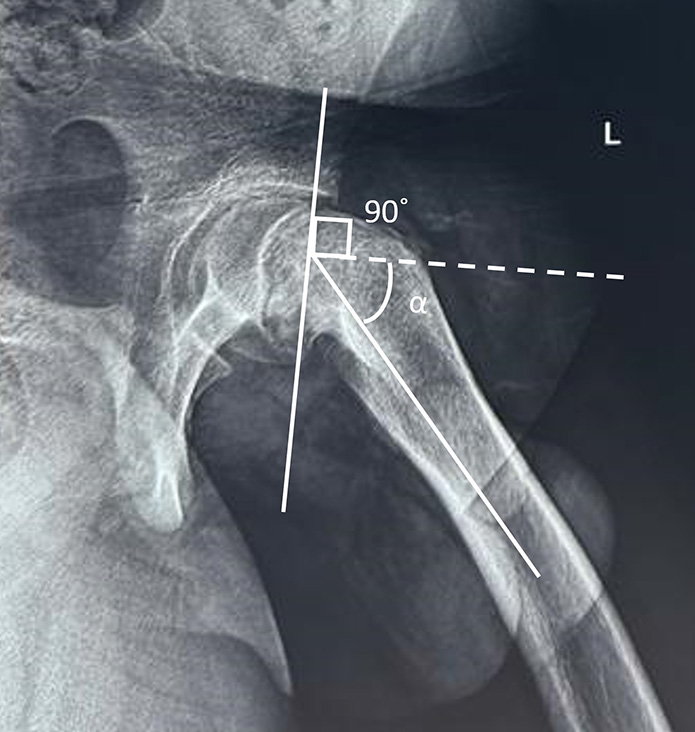 Southwick angle. On the frog-leg lateral view, a line is drawn along the axis of the femoral shaft. Another line (dotted) is drawn perpendicular to a line connecting the anterior and posterior margins of the physis. The angle between these two lines is the Southwick angle (alpha).