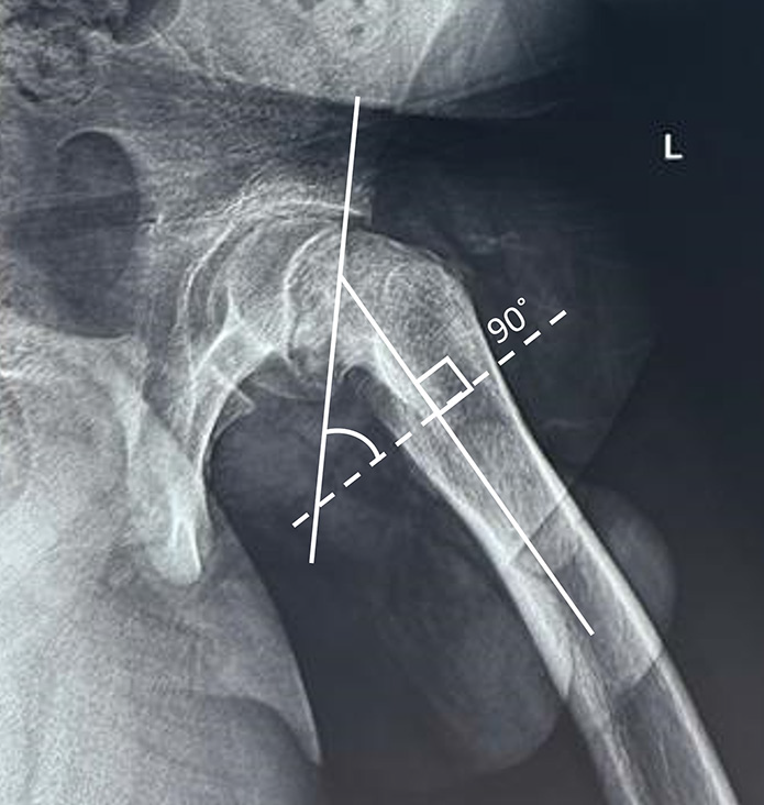 Posterior sloping angle. Two lines are drawn on frog-leg lateral view, one connecting the ends of femoral physis and the other along the femoral shaft axis. Then, a line is drawn perpendicular to the axis of the femoral shaft (dotted line) and the angle between this line and the physeal line is the posterior sloping angle.