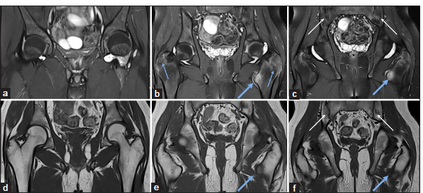 (a-f) A 15-year-old child with a known case of juvenile idiopathic arthritis (JIA) presented with a recent onset of worsening pain. (a-c) Magnetic resonance imaging pelvis - short-tau inversion recovery coronal and (d-f) T1-weighted coronal images demonstrate moderate left hip joint synovitis and effusion and mild right hip joint synovitis and effusion. There is chronic bilateral inflammatory sacroiliitis (white arrows in c and f), significant enthesitis at the left iliopsoas tendon with associated bone marrow edema in the lesser trochanter (thick blue arrow in b,c,e and f), and mild enthesitis at the bilateral greater trochanter (thin blue arrow in b), suggests entheseal related arthritis subtype of JIA.