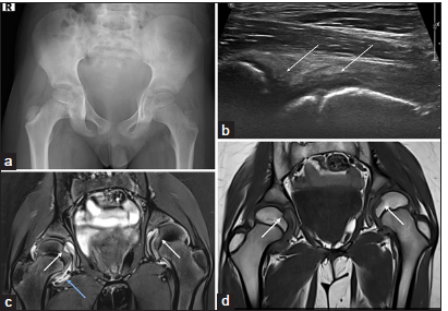 (a-d) An 8-year-old child with right hip pain for 6 months. (a) Anteroposterior radiograph of the pelvis shows mild juxtaarticular osteopenia on the left side. (b) Ultrasound of the hip joint showed mild synovitis (thin white arrows) in the right hip joint, and the left hip joint was unremarkable. (c) Magnetic resonance imaging pelvis - short-tau inversion recovery coronal and (d) T1-weighted coronal images demonstrate mild to moderate synovitis in the right hip joint (blue arrow in c) and minimal synovitis in the left hip joint with widening of the bilateral foveal (short white arrows in c and d) which suggests erosion and is a classical feature of inflammatory arthritis.