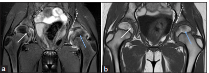 (a-b) A 10-year-old child, a known case of juvenile idiopathic arthritis, presented with a recent onset of worsening hip pain. (a) Magnetic resonance imaging pelvis - short-tau inversion recovery coronal and (b) T1-weighted coronal images demonstrate mild synovitis in the bilateral hip joint, focal bone marrow edema-like signal in the left femoral head (blue arrow in a and b), which is considered pre-erosive abnormality. There is also a widening of the bilateral fovea (short white arrow in a and b) and a widening of the bilateral acetabular notch (thin white arrow in a and b), a classical imaging feature of inflammatory arthritis.