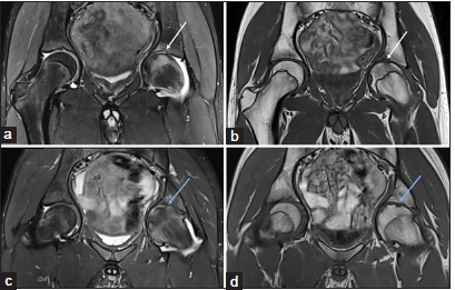 (a-d) A 14-year-old child with a known case of juvenile idiopathic arthritis presented with a recent onset of worsening hip pain. (a) Initial magnetic resonance imaging (MRI) pelvis - short-tau inversion recovery (STIR) coronal and (b) T1-weighted coronal images demonstrate mild synovitis and effusion in the left hip joint and focal bone marrow edema-like signal in the left femoral head (white arrow in a and b) and progress to definite erosion (blue arrow in c and d) as seen in the follow-up MRI’s (c) STIR and (d) T1W coronal images.