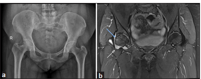 A 40-year-old lady with right hip pain and stiffness. (a) An anteroposterior pelvis radiograph shows a narrowing of the right hip joint space. (b) Magnetic resonance imaging pelvis - short-tau inversion recovery coronal image show synovitis and effusion with erosions and subtle bone marrow edema (blue arrow).