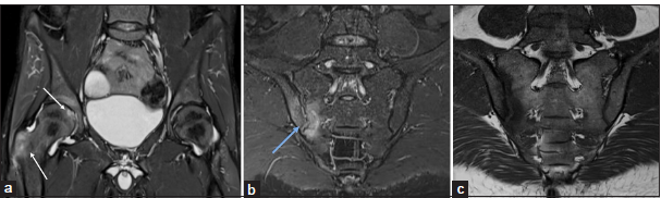 (a-c) A 30-year-old male known case of psoriasis with inflammatory low back and hip pain. (a) Magnetic resonance imaging pelvis - short-tau inversion recovery (STIR) coronal image shows bilateral hip joint synovitis and effusion with active enthesitis at the right greater trochanter and the ligamentum teres attachment at the fovea (white arrows). (b and c) STIR oblique and T1 oblique coronal images of the sacroiliac joints demonstrate articular surface erosions and bone marrow edema (blue arrow) on the right side, and the left sacroiliac joint is unremarkable. These imaging features of asymmetric sacroiliitis and enthesitis suggest psoriatic spondyloarthropathy.