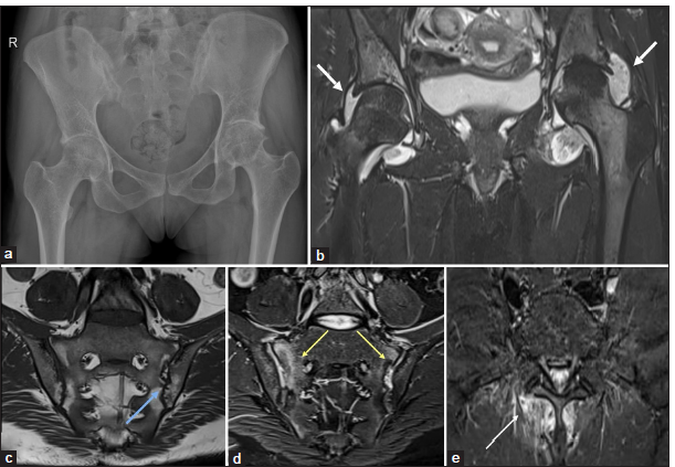 28-year-old lady with inflammatory low back and hip pain. (a) Anteroposterior pelvis radiograph shows diffuse osteopenia, bilateral hip joint space narrowing and erosions, and also subchondral sclerosis of bilateral sacroiliac joints. (b) Magnetic resonance imaging pelvis - short-tau inversion recovery (STIR) coronal image shows significant bilateral hip joint synovitis and effusion (short white arrows). (c and d) T1-weighted oblique and STIR oblique coronal images of the SI joints demonstrate bilateral articular surface erosions with juxta-articular fatty marrow replacement (blue arrow) and bone marrow oedema (yellow arrows). (e) STIR oblique axial image shows active enthesitis of paraspinal muscles (thin white arrow).