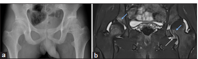 A 15-year-old child with a known case of juvenile idiopathic arthritis presented with a recent onset of worsening hip pain. (a) An anteroposterior pelvis radiograph shows a narrowing of the bilateral hip joint space and erosions in the left femoral head and (b) Magnetic resonance imaging pelvis - short-tau inversion recovery (STIR) coronal image clearly demonstrates active disease evident as moderate joint effusion and synovitis (white arrows) and structural changes evident as erosions (blue arrows).