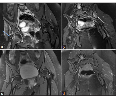 A 15-year-old child with a known case of juvenile idiopathic arthritis. (a and b) Initial magnetic resonance imaging pelvis – short-tau inversion recovery (STIR) coronal images demonstrate active disease evident as mild right hip joint synovitis (blue arrow in a) and bone marrow edema and synovitis in bilateral sacroiliac joints (white arrows in b). (c and d) The follow-up MRI’s STIR coronal images after a course of biologics show complete resolution of synovitis and bone marrow edema.