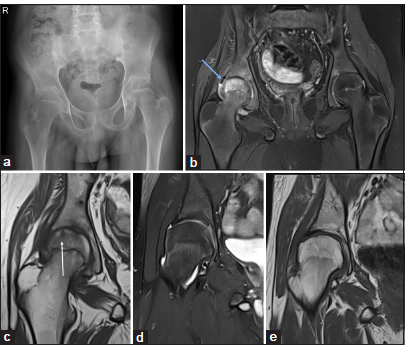 (a-e) A 14-year-old child with a known case of juvenile idiopathic arthritis presented with a recent onset of right hip pain. (a) An anteroposterior pelvis radiograph shows bilateral hip joint space narrowing and juxta-articular osteopenia; these changes are more pronounced on the right side. (b) Initial magnetic resonance imaging pelvis – short-tau inversion recovery (STIR) coronal image demonstrates mild right hip joint synovitis and severe bone marrow edema in the right femoral head (blue arrow). (c) The corresponding T1-weighted coronal image shows insufficiency fractures (white arrow). (d and e) After a course of conservative management, the follow-up MRI’s STIR and T1W coronal images show complete resolution of insufficiency fracture and bone marrow edema.