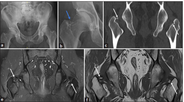 A 40-year-old man with right hip pain. (a) The anteroposterior radiograph of the pelvis and the (b) magnified radiograph shows a calcified focus along the inner surface of the right greater trochanter (blue arrow). (c) The computed tomography coronal and (d) magnetic resonance imaging pelvis - short-tau inversion recovery coronal and (e) T1-weighted coronal images show a calcific deposit in the bilateral obturator internus tendons (white arrows in c-e) suggest calcific tendonitis. No calcifications, significant effusion or synovitis in the bilateral hip joints.