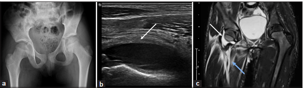 A 14-year-old child with acute onset right hip pain and restricted movements. (a) Anteroposterior pelvic radiograph appears normal except for a mild pelvic tilt to the right side which could even be positional. (b) Ultrasound of the hip joint showed significant right hip joint effusion (white arrow) with distension of the capsule and (c) magnetic resonance imaging of pelvis – short-tau inversion recovery (STIR) coronal image show effusion (white arrow) and ill-defined edema along the myofascial planes of the proximal thigh (blue arrow) suggesting infective arthritis.