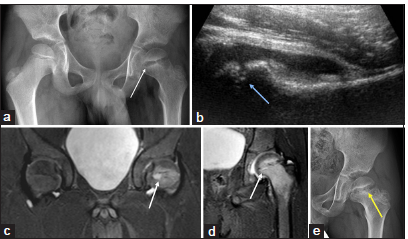 A 9-year-old child with left hip pain. (a) Anteroposterior pelvic radiograph shows a widening of the left physis (thin white arrow) and osteopenia of the left proximal femur. (b) Ultrasound of the left hip joint shows effusion and widening of the peripheral physis (blue arrow). (c and d) Magnetic resonance imaging of pelvis – short-tau inversion recovery coronal images clearly demonstrate a small abscess in the proximal femoral physis (short white arrows in c and d) with the resultant widening of the physis and associated adjacent bone marrow oedema and hip joint effusion suggesting co-existing osteomyelitis and infective arthritis. (e) The follow-up anteroposterior pelvic radiograph of the pelvis demonstrates focal bony physeal bars in the proximal left femur (yellow arrow).