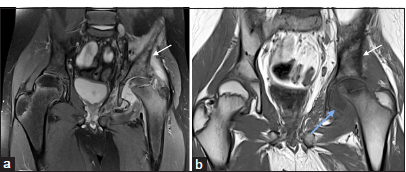 A 12-year-old child with left hip infective arthritis. (a and b) Magnetic resonance imaging of pelvis – short-tau inversion recovery coronal image shows moderate left hip joint effusion with synovitis, which appears as a hyperintense rim on T1-weighted coronal image (blue arrow), suggesting vascularised granulation tissue. There is a widening of the proximal femur physis and a poorly defined bone marrow edema-like signal in the left proximal femur and ilium, which appears hypointense on T1-weighted images (white arrow in a and b); this suggests coexisting osteomyelitis.