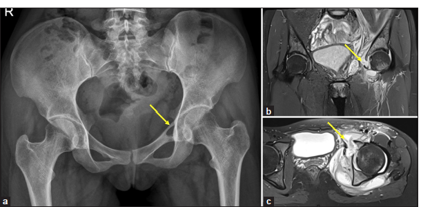 (a-c) A 40-year-old lady with left hip pain and restricted movements. (a) Anteroposterior pelvic radiograph shows a defect (yellow arrow) in the medial wall of the left acetabulum and increased soft tissue opacity in the peri-acetabular region. (b and c) Magnetic resonance imaging of pelvis – short-tau inversion recovery coronal and axial images show significant left hip joint effusion, bone marrow edema in the acetabulum with a defect in the medial acetabular wall (yellow arrow), suggests septic arthritis with osteomyelitis and extensive collections and edema in the obturator internus muscle extending to the anterior subcutaneous plane.