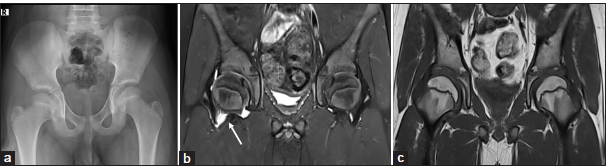 (a-c) An 8-year-old child with recent onset of the right hip pain and limp. No fever. (a) Anteroposterior pelvic radiograph is unremarkable. (b and c) Magnetic resonance imaging of pelvis – short-tau inversion recovery (STIR) and T1-weighted coronal images show mild effusion and synovitis in the right hip joint (white arrow in b). No edema or collections in the peri-articular soft tissues. No bone marrow edema or erosions.